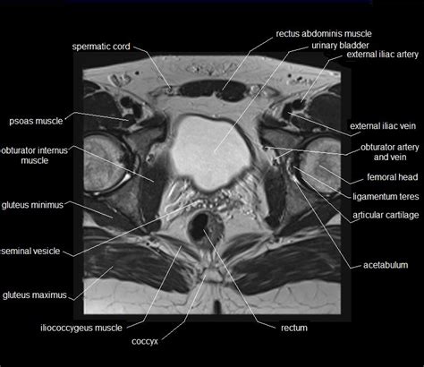 What Are Pelvis Mris Prattville Imaging Center Montgomery Al