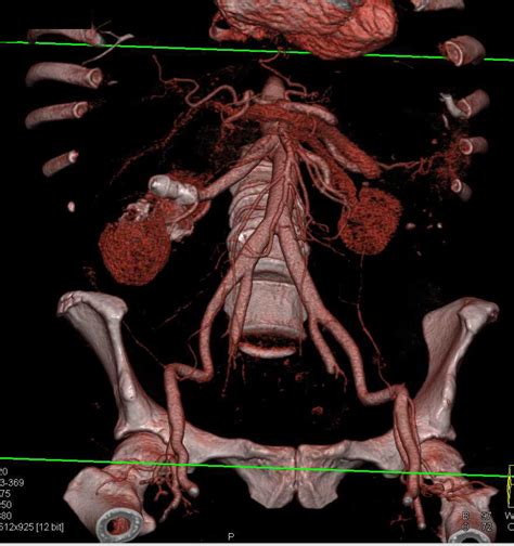 Complex Cysts Right Kidney With Calcifications Kidney Case Studies