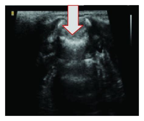 A Ultrasonography In The Sagittal Plane Showing A Medullary Cone