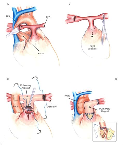 Surgical Repair Of Stenotic Pulmonary Arteries In Tetralogy Of Falllot