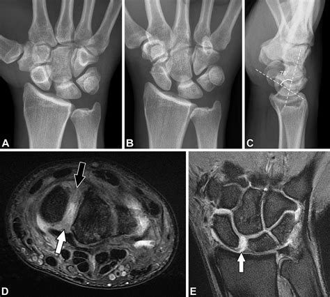 Preoperative And Postoperative Imaging Of Scapholunate Ligament Primary