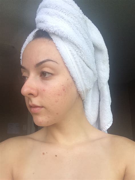 My Skins Journey Week 36 Banish Acne Scars