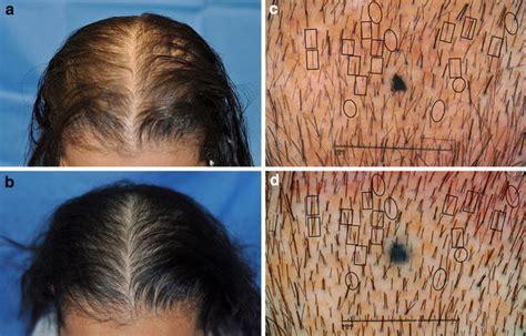 Male And Female Pattern Hair Loss Before And After Lasercomb Treatment