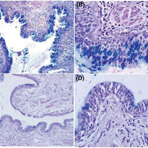 Comparison Of Airway Goblet Cell Hyperplasia In Non‐cystic Fibrosis