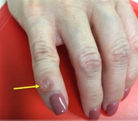 Mucous Cyst Hand Surgery Resource