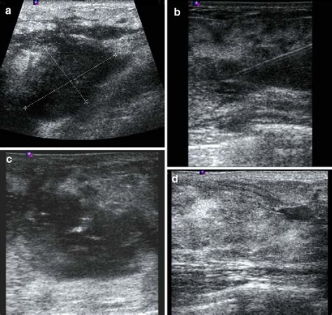 Treatment Of Breast Abscesses With Ultrasound Guided Aspiration And