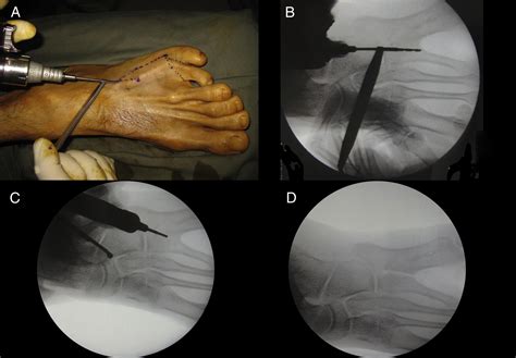 Correction Of Postaxial Metatarsal Polydactyly Of The Foot By Percutaneous Ray Amputation And