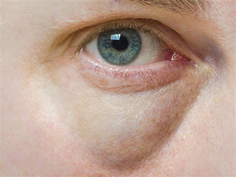 Injections Relieve Graves Disease Eyelid Complication Medpage Today