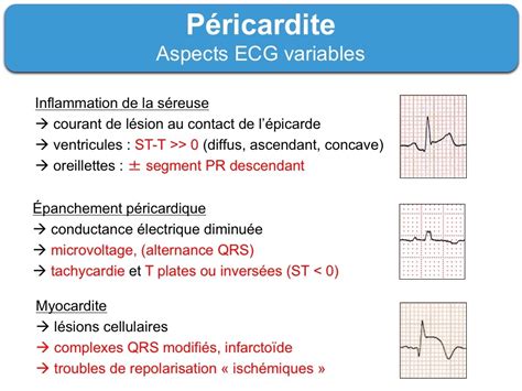 1) hospit si ≥1 facteur majeur (<20% des cas) = fièvre >38, symptomes depuis plusieurs j/sem avec début subaigu, épanchement abondant (>2 cm)/tamponnade, résistance aux ains depuis 1 sem. Péricardite aiguë. 1 typique : e-cardiogram