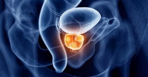 Cáncer de próstata avanzado primer reporte de un programa especializado NetMD From MDHealth