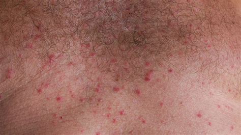 The Best 5 What Causes Red Bumps On Skin That Itch Domoveru