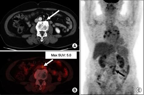 True Positive Case Lymph Node Metastasis A 72 Year Old Female Had A