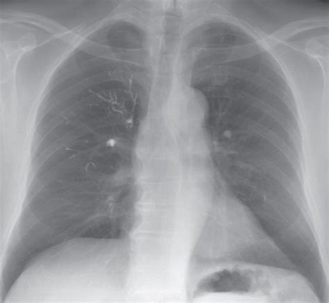 White Spot On Lung X Ray