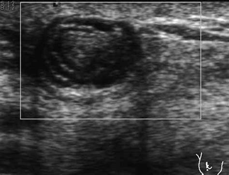 Breast Sonography Showing A Smooth Rounded Nodule With Heterogeneous