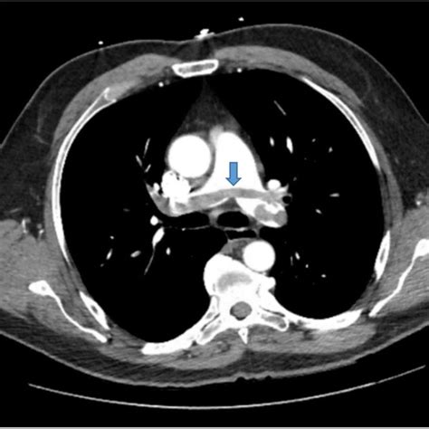 Computed Tomography Ct Angiogram Of The Chest Lung Window Showing