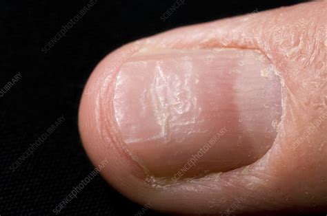 Fingernail Pitting Due To Eczema Stock Image C0069156 Science