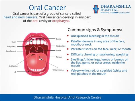 Throat cancer is a general term that applies to cancer that develops in the throat (pharyngeal cancer) or in the voice box (laryngeal cancer). Velscope - Get Your Smile Back
