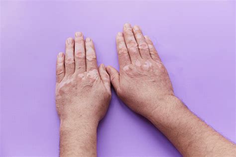 Menunjukkan Masalah Vitiligo Tangan Pada Latar Belakang Ungu Masalah