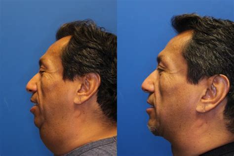 Neck Lift Before And After Photo Gallery San Francisco Ca Kaiser