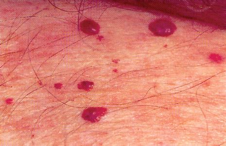 Campbell de morgan spots arise from blood vessels within the surface of the skin. Red Spots or Blood Spots | Red Spots Bristol
