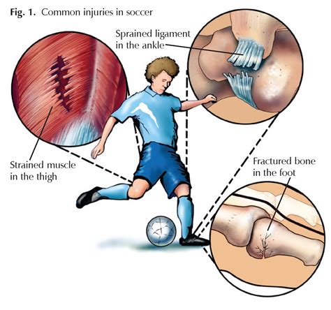 Soccer Players Sprains Strains And Breaks Hughston Clinic