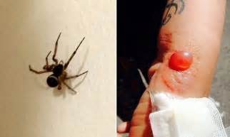 Your doctor will only use this treatment after they've spoken with another doctor who has experience in treating these bites. Pictured: Horror bite of false widow spider leaves pub ...