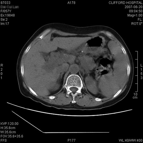 Typical Cases Gastric Cancerclifford Hospital