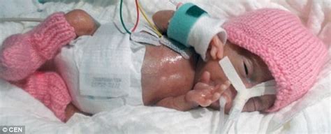 1000000 weeks = 229979.47 months. "World's Tiniest Baby" Born At 25 Weeks Weighing Just 8 ...