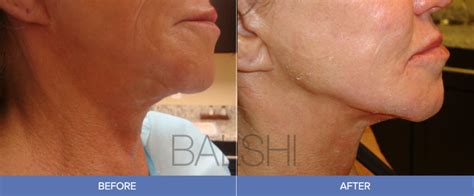 Thermitight® Delray Beach Tighten Your Skin At Balshi Dermatology