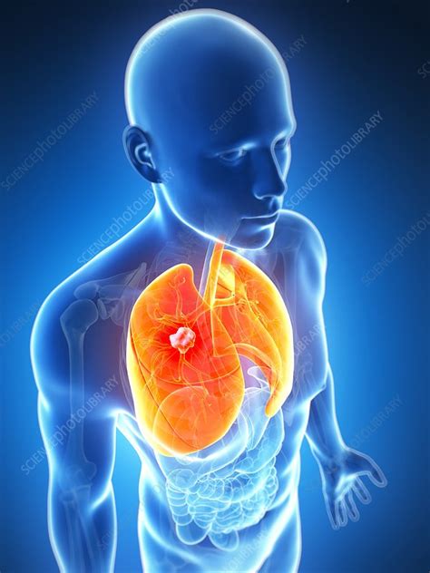 Human Lung Cancer Artwork Stock Image F0096792 Science Photo