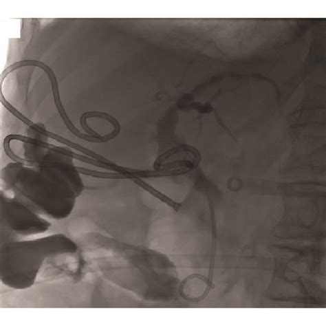 Cholangiogram At Ercp Showing An 8 Mm Common Bile Duct Stone With