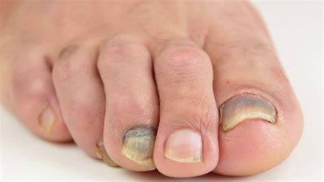 Santa Barbara Podiatrist Foot Doctor Talks About Discolored Toenails