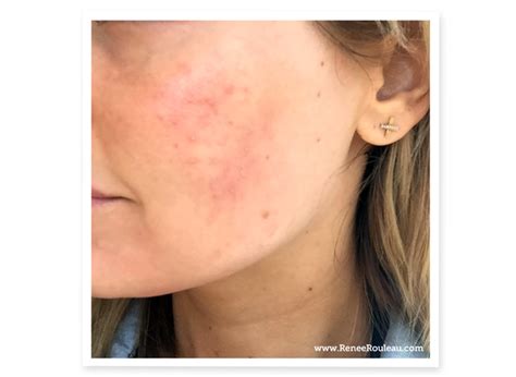 Acne Cosmetica Cosmetic Acne What It Is Causes And How To Treat It