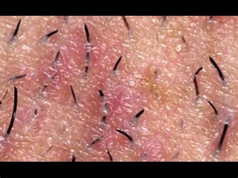 ingrown hairs from shaving - medical term for ingrown hairs HD 