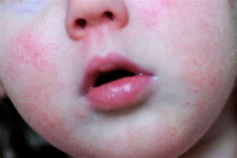 Scarlet Fever Warning Issued To Parents As 28500 Cases Recorded This
