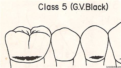 Dental Caries Gv Black Classification Of Carious Lesions