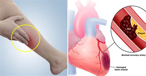 Clotting of blood in the blood vessels is the blockage of the blood vessels by excess cholestrol,calcium and platelets. 8 Early Warning Signs Of A Blood Clot You Should Never ...