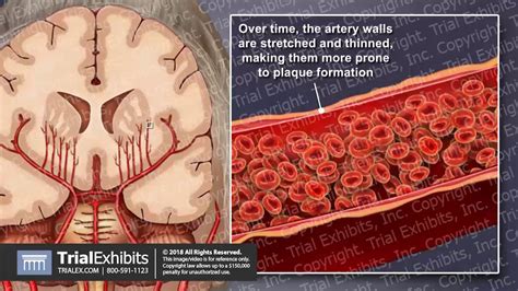 Cerebral Small Vessel Disease Leading To Ischemic Stroke Youtube