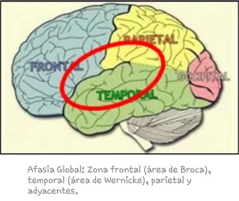 Afasia Definición tipos y características NeuroClass