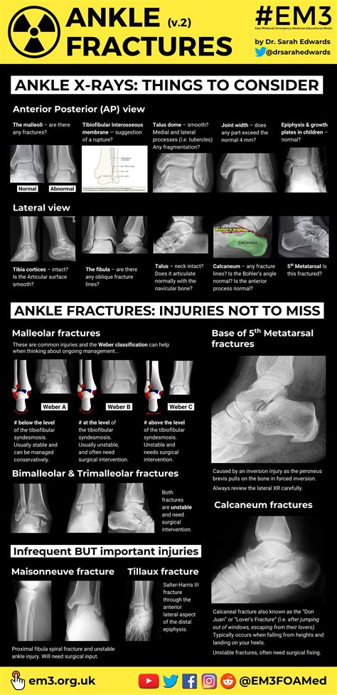 Ankle Xrays Ankle Fractures Things To Consider By Grepmed