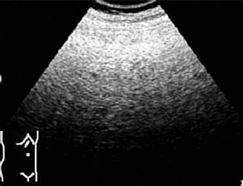 S3 Severe Steatosis Bright Liver With Intense Posterior Attenuation