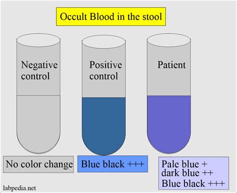 Stool Examination Part 5 Stool For Occult Blood Ob Fecal Occult
