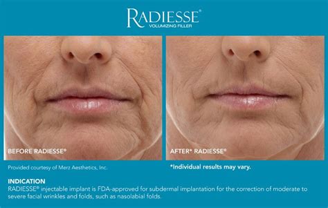 Radiesse In New Jersey Soma Skin And Laser