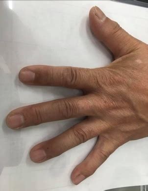 【症例解説】手指DIP関節痛の鑑別で重要な爪・皮膚・罹患関節 ...