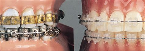 This Image Shows Fully Banded Braces Circa 1970 With Each Tooth Encircled By A Metal Band