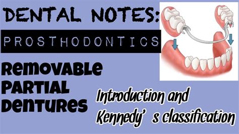 Study With Me I Dental Notes I Removable Partial Denture I Kennedys