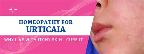 Homeopathic Treatment For Urticaria Homoeocare