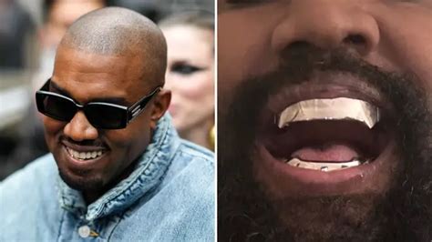 Kanye West Has Teeth Removed And Replaced With 850000 Titanium