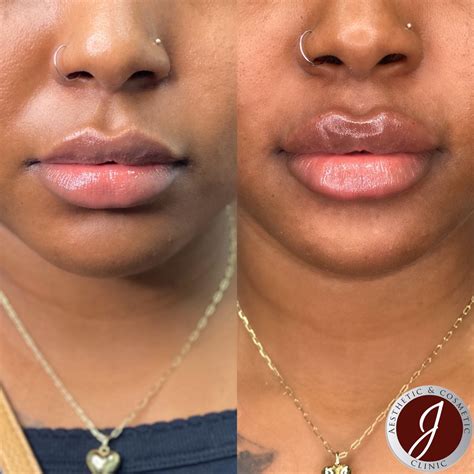 enhance your lips with russian lip augmentation