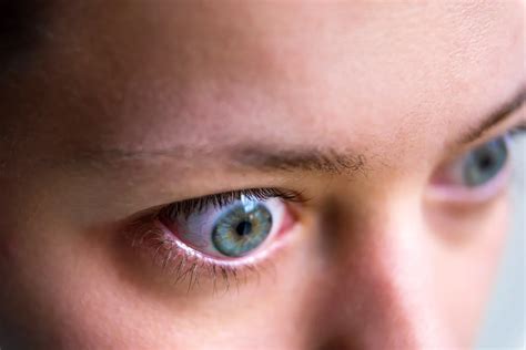Bulging Eyes Exophthalmos 5 Causes Of Protruding Eyes